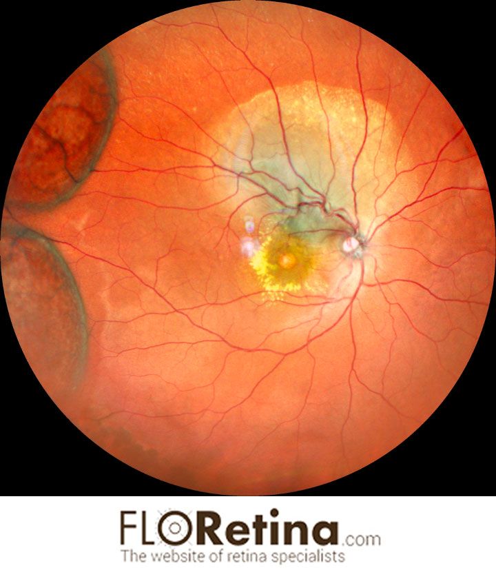 Choroidal tubercoloma and peripheral retinoschisis