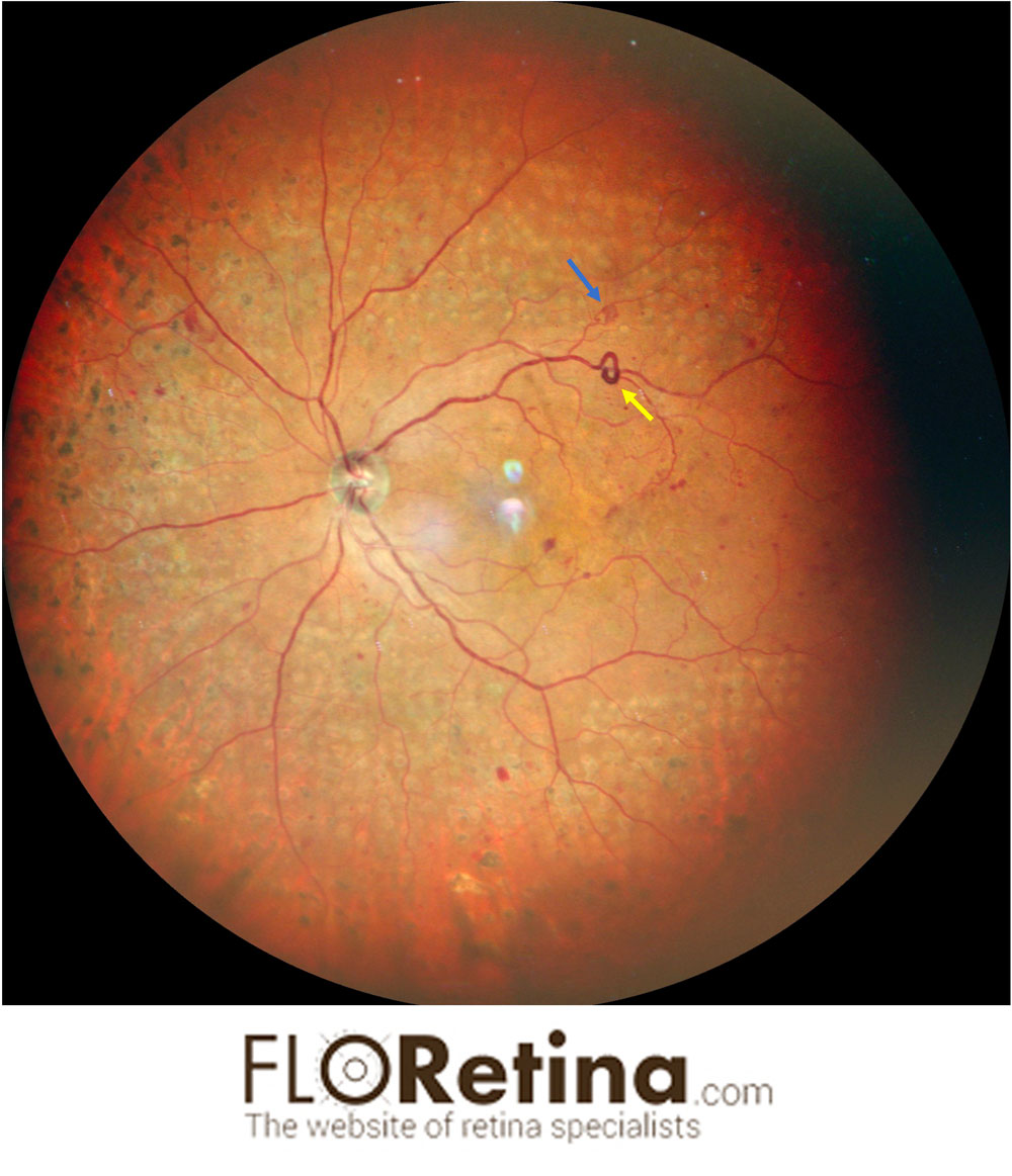 Proliferative Diabetic retinopathy
