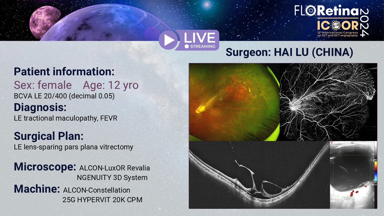 LE tractional maculopathy, FEVR