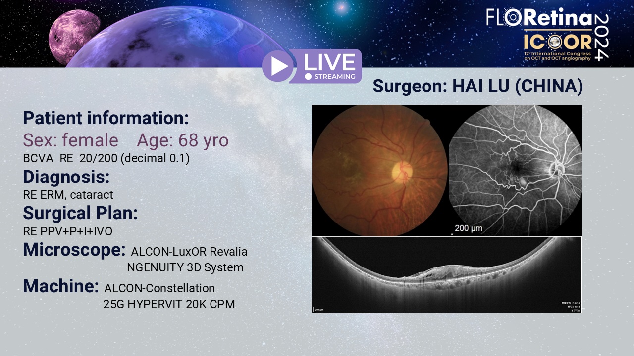 RE ERM, cataract