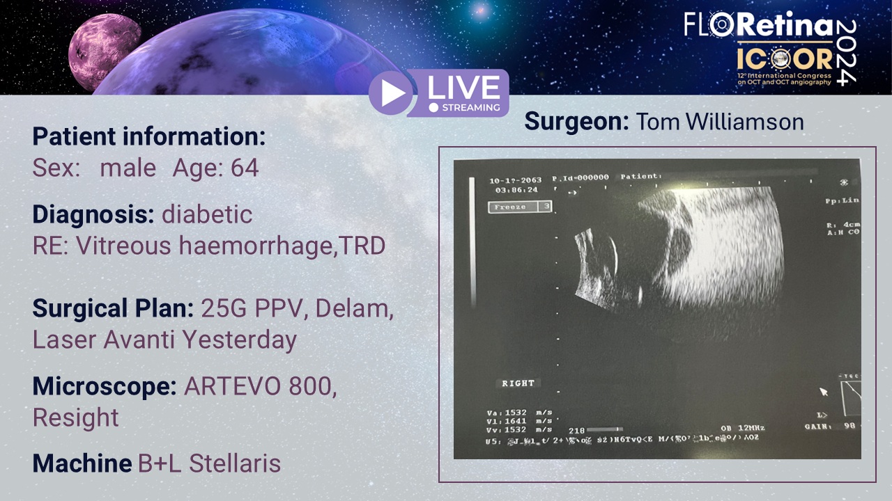 Diabetic, RE vitreous hemorrage, TRD