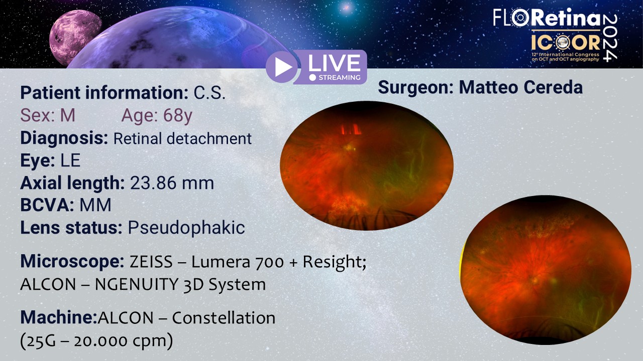 Retinal detachment