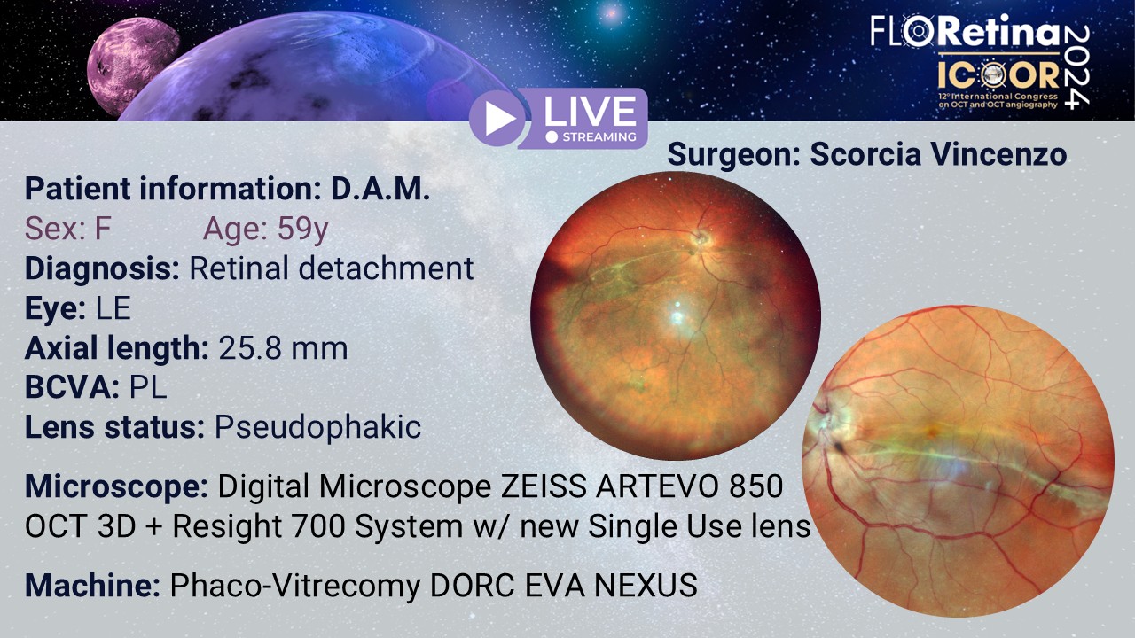 Retinal detachment