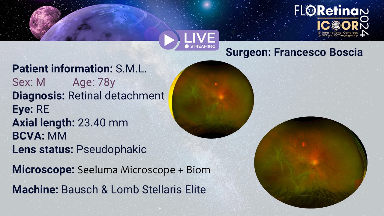 Retinal detachment