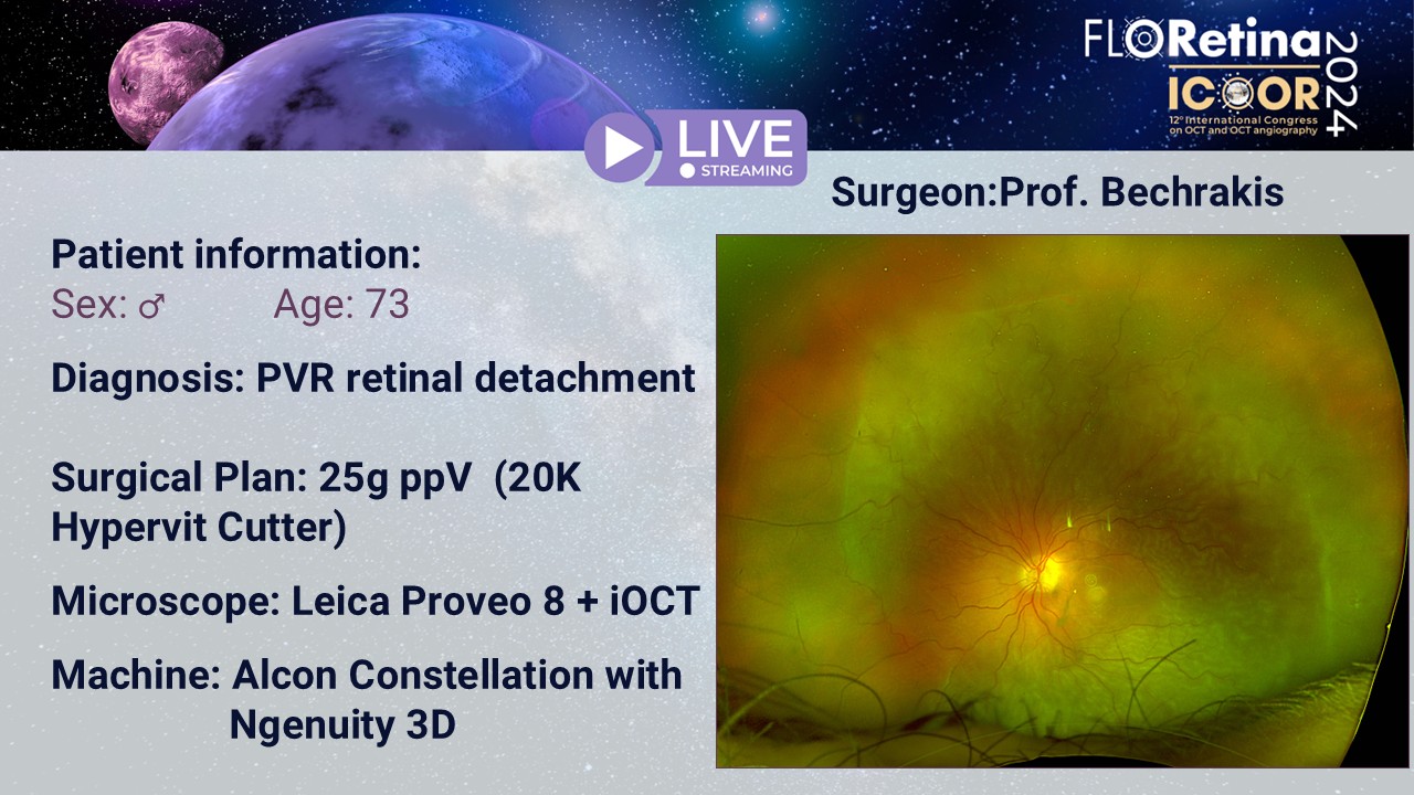 PVR retinal detachment