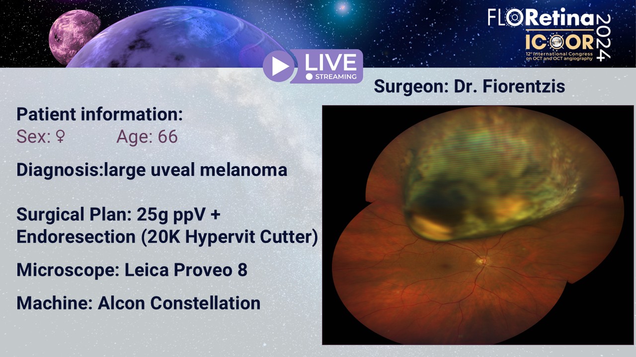 Large uveal melanoma