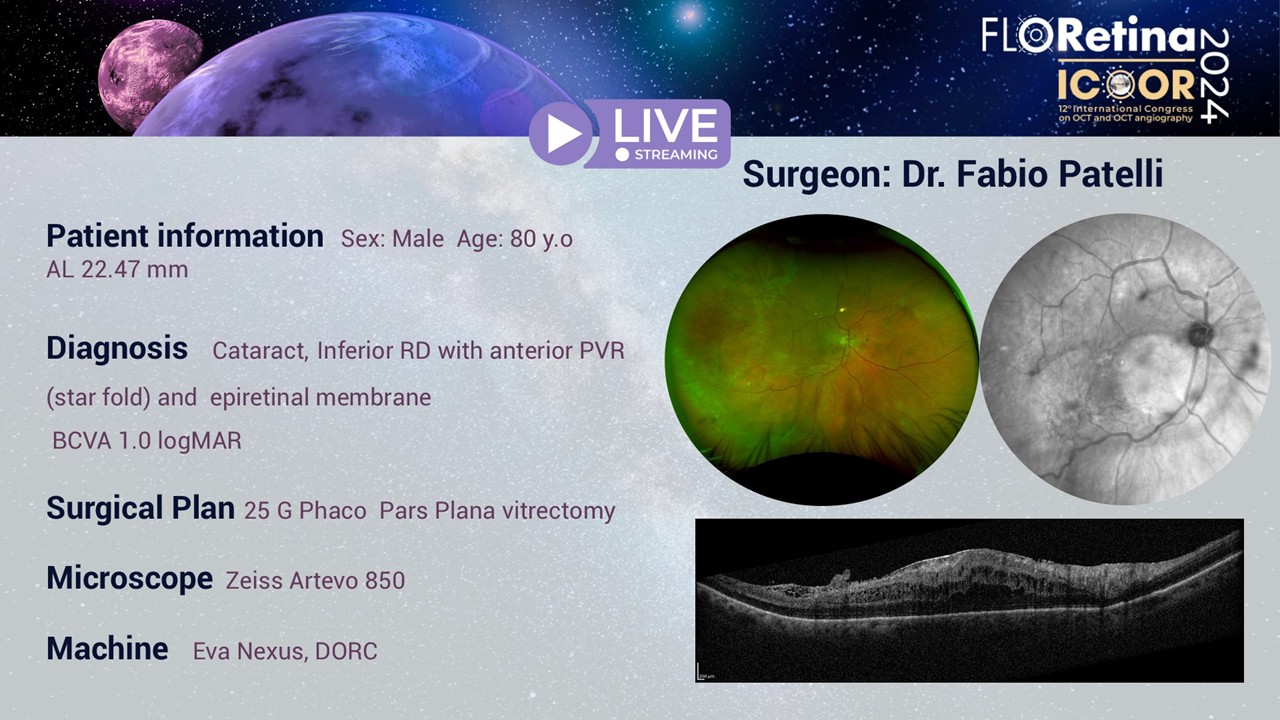 Inferior RD with anterior PVR and epiretinal membrane