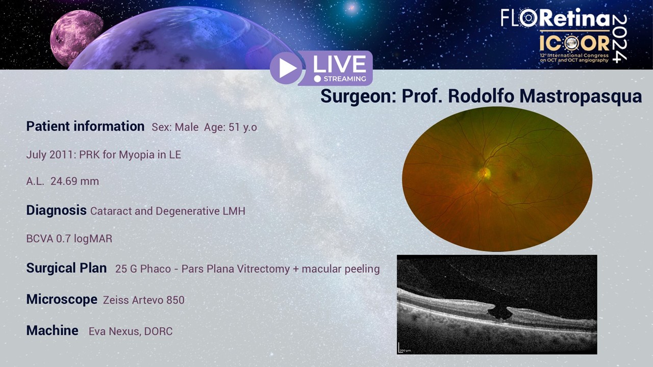 Cataract and degenerative LMH