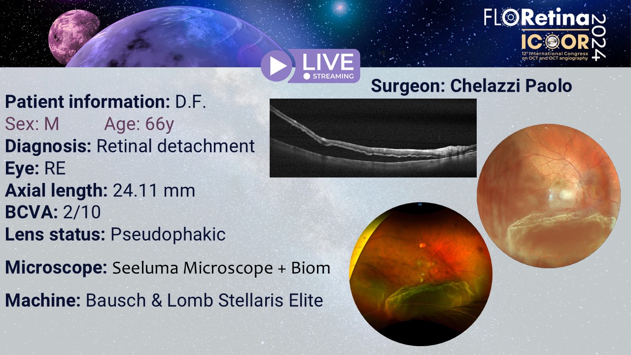 Retinal detachment