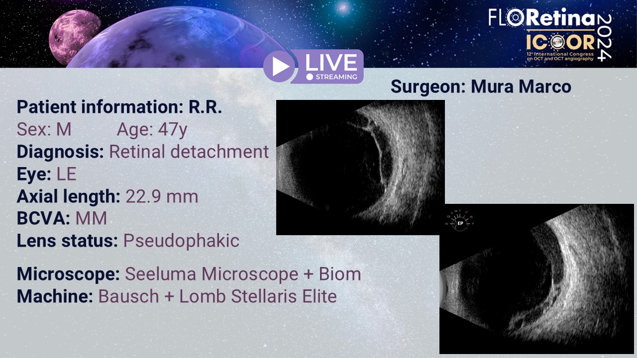 Retinal detachment