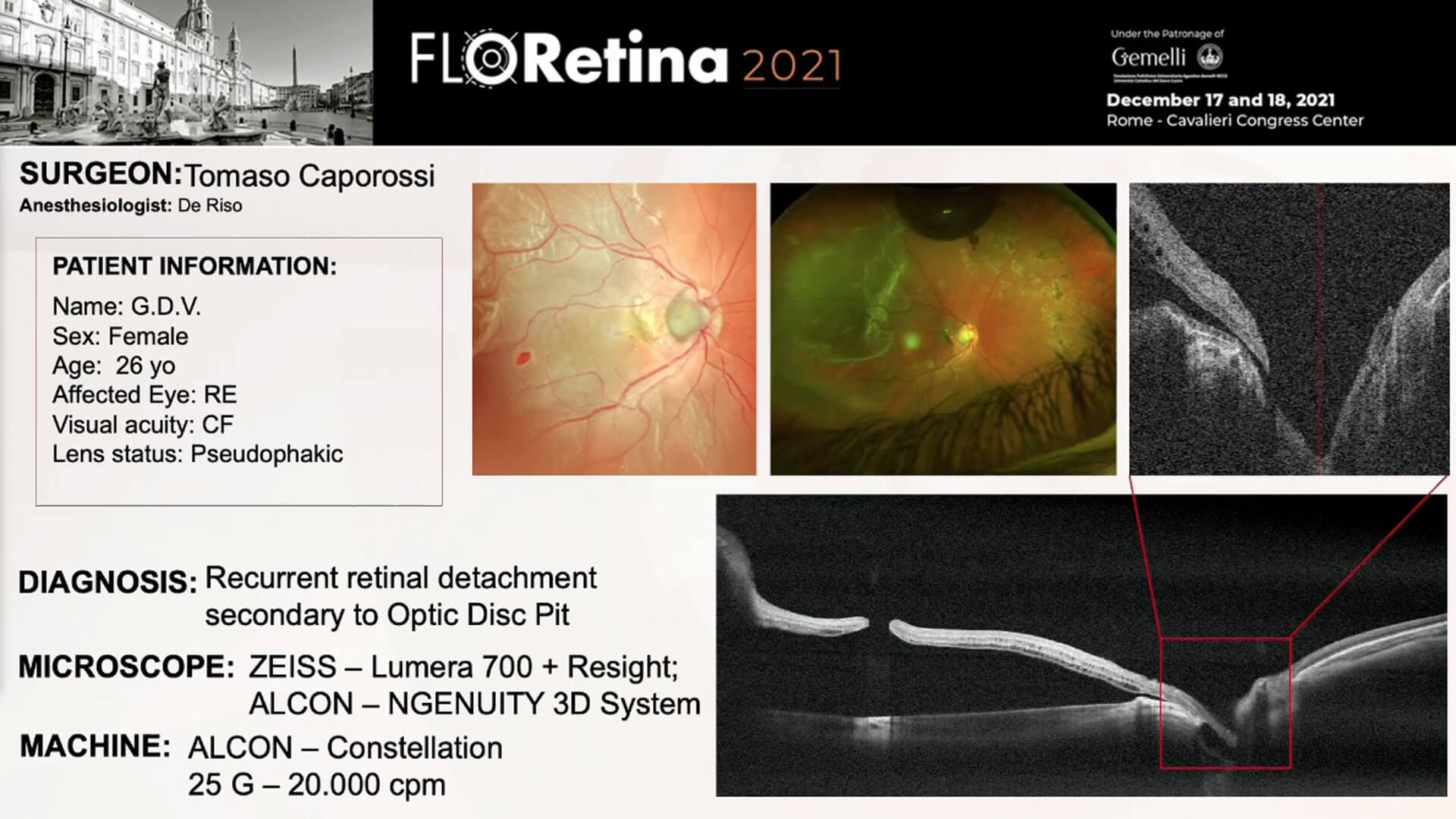 Recurrent retinal detachment secondary to Optic Disc Pit