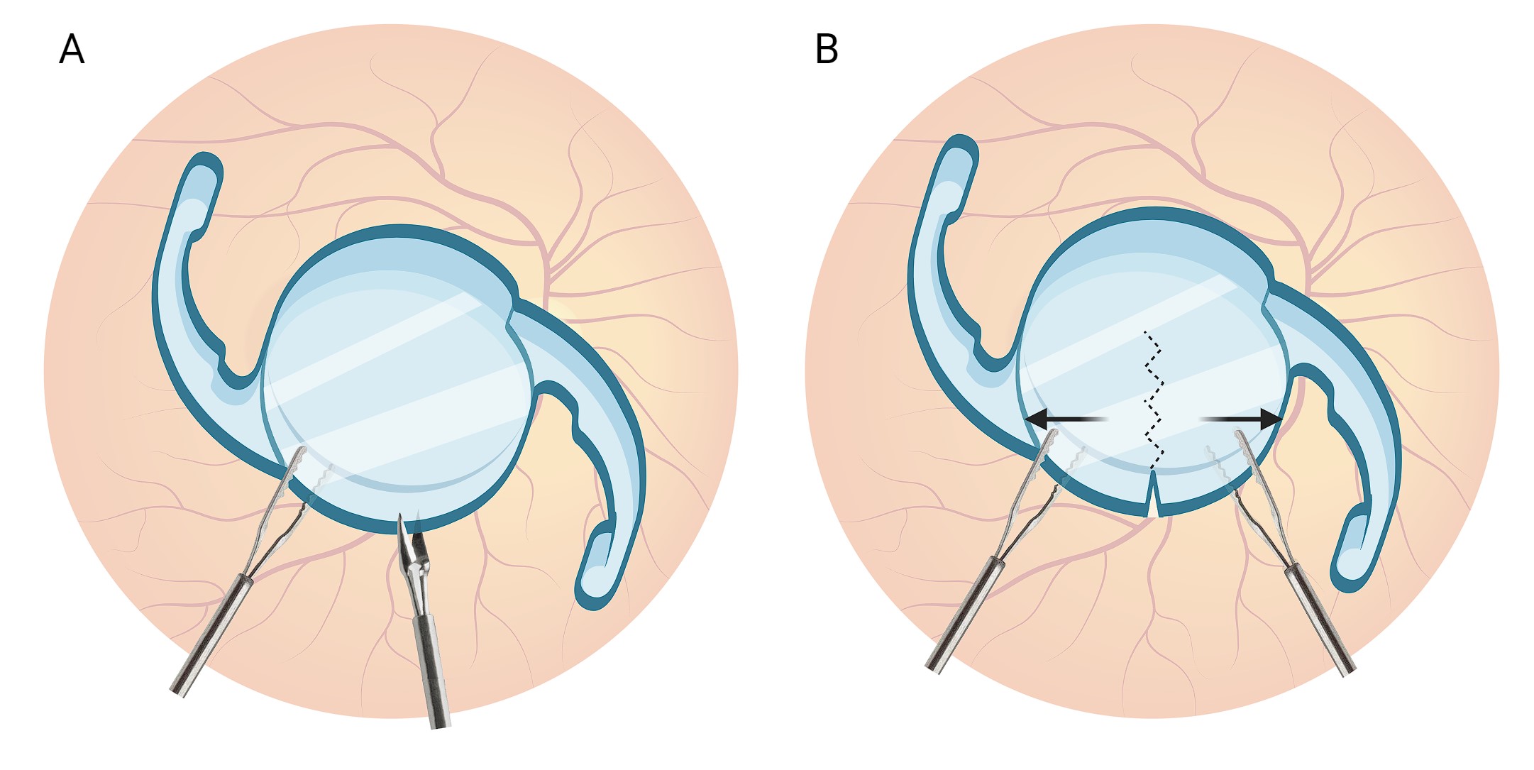An Alternative Technique For Intraocular Lens Removal: Bimanual Cleavage In The Vitreous Chamber