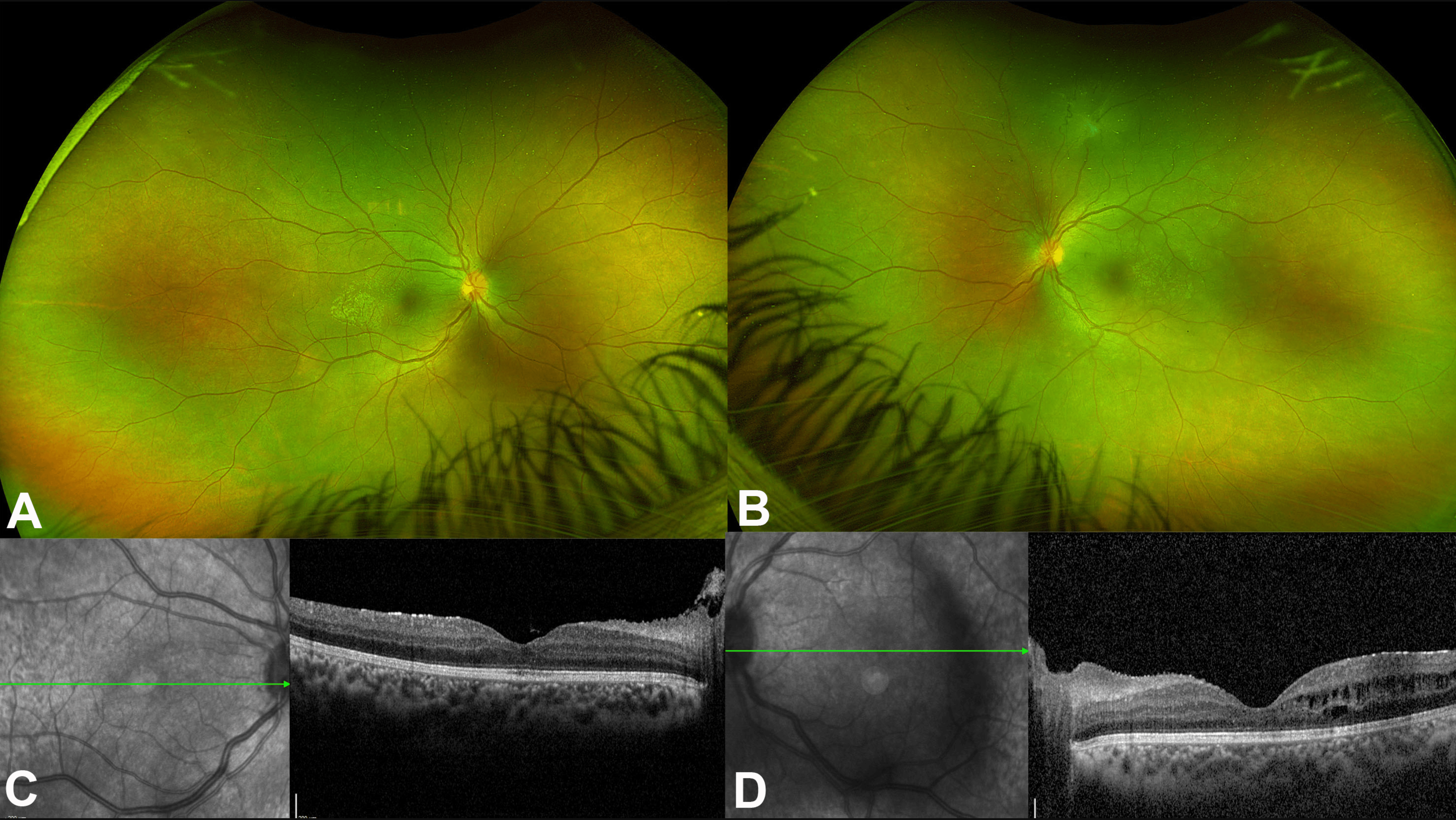 Optic disc neovascularization (NVD) associated with pediatric uveitis