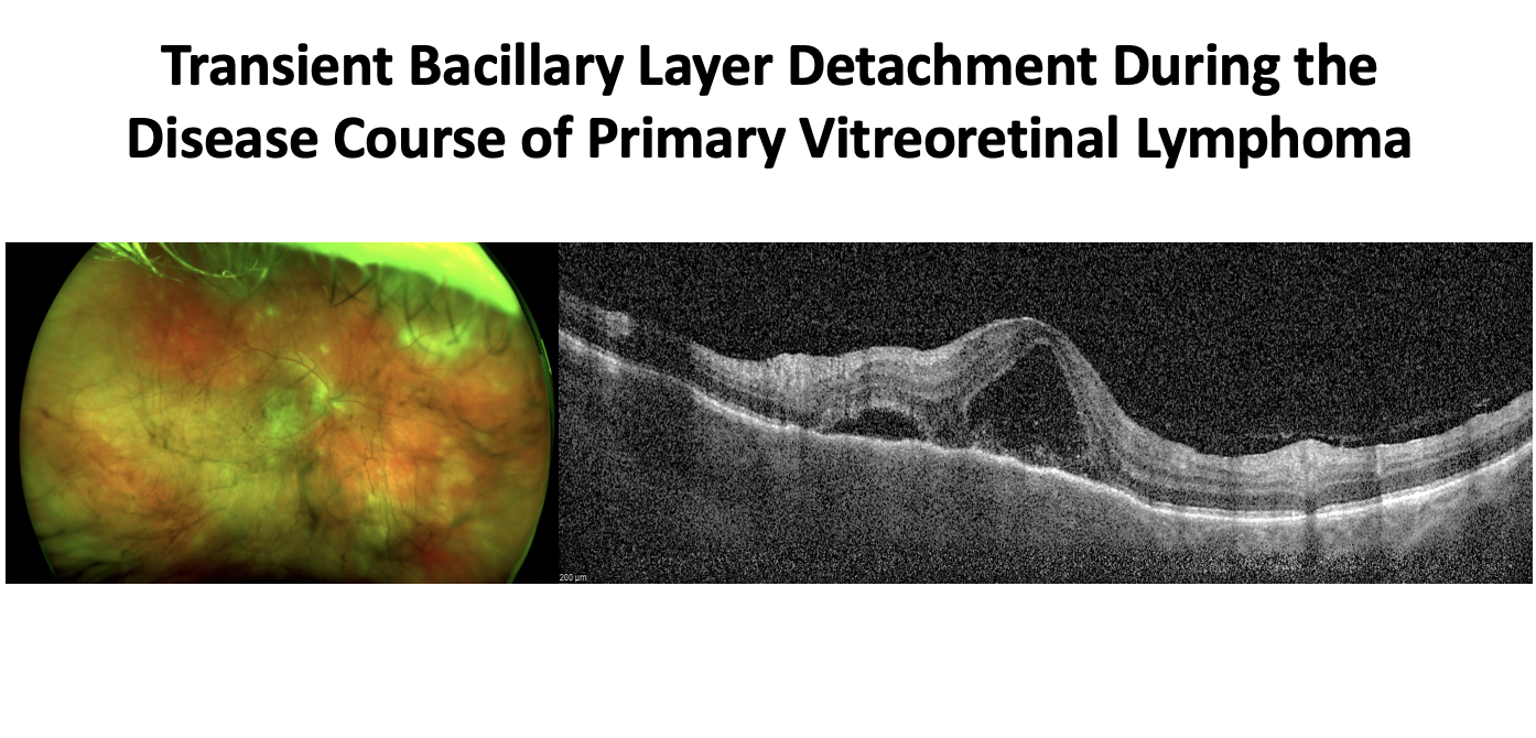 Transient Bacillary Layer Detachment During the Disease Course of Primary Vitreoretinal Lymphoma