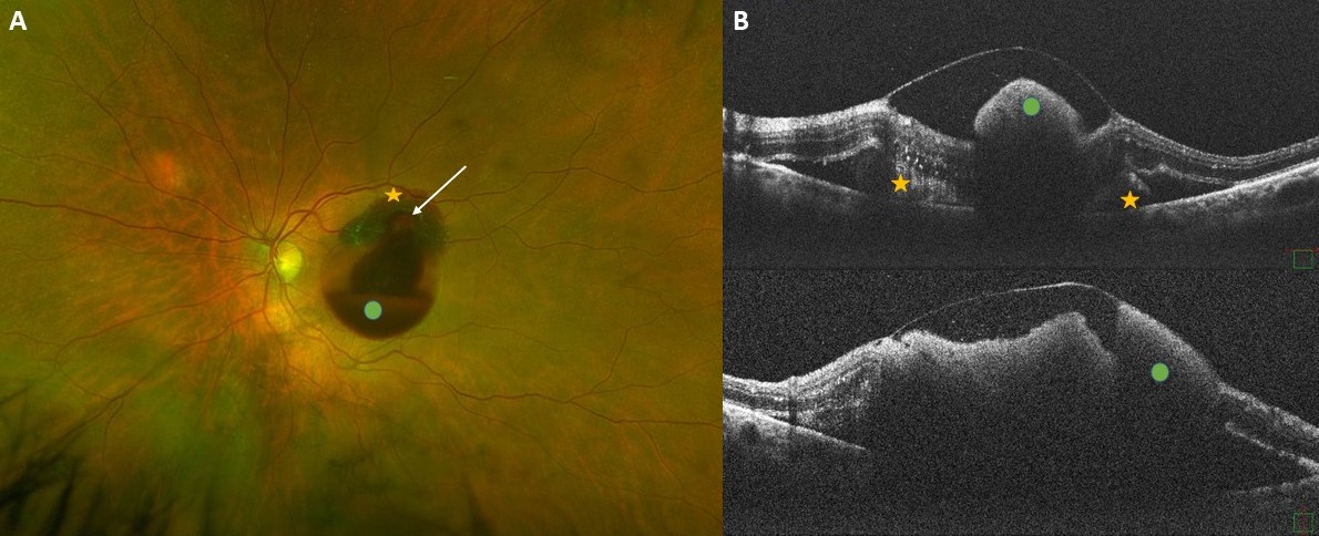 Imaging of a retinal arterial macroaneurysm