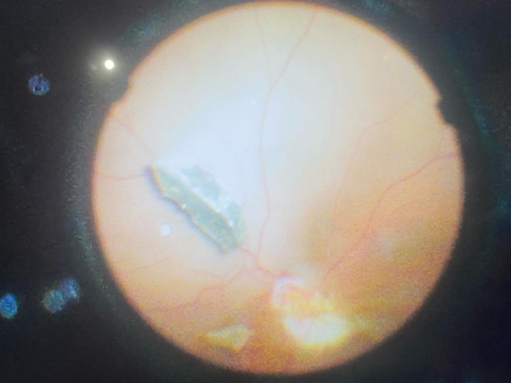 Retained iofb presenting as vitreous haemorrhage