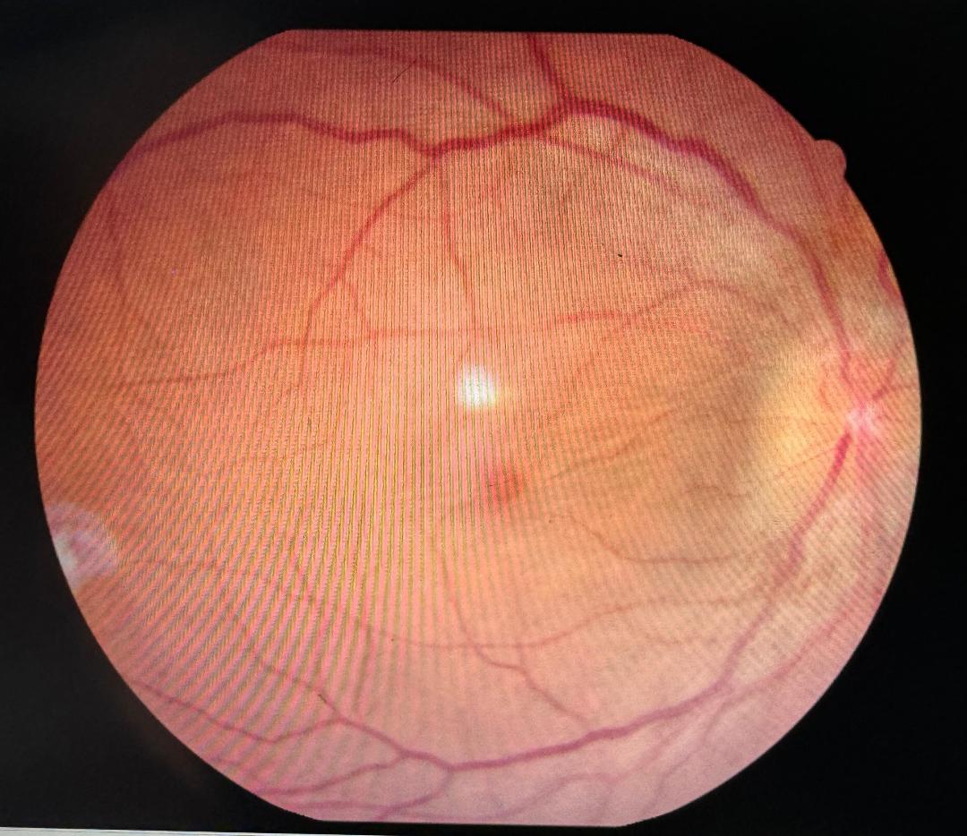 Letrozole-induced unilateral acute intermediate uveitis with cystoid macular edema