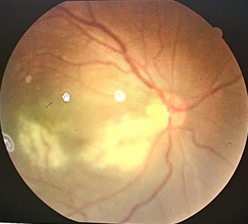 Rickettsial retinitis
