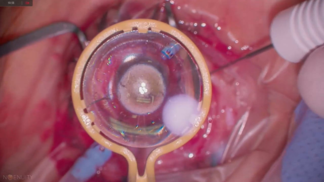 PPV, IOL explant, Carlevale IOL placement