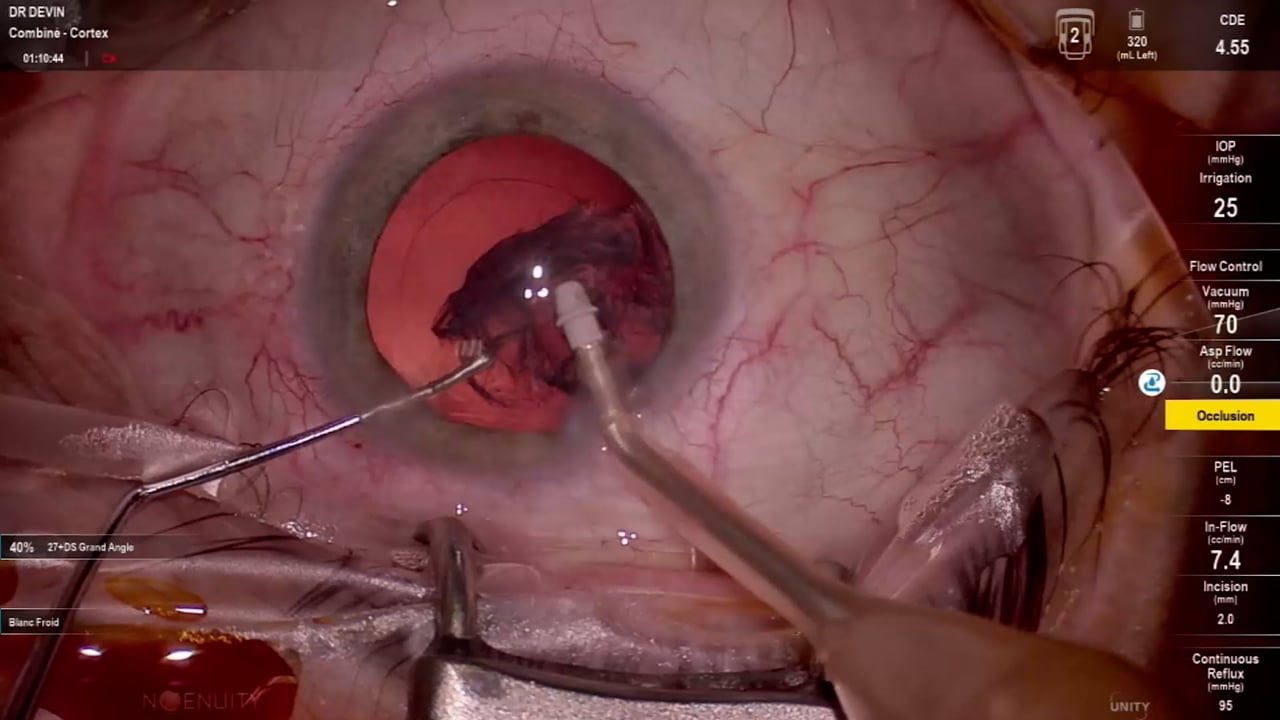 DME with severe non proliferative diabetic retinopathy