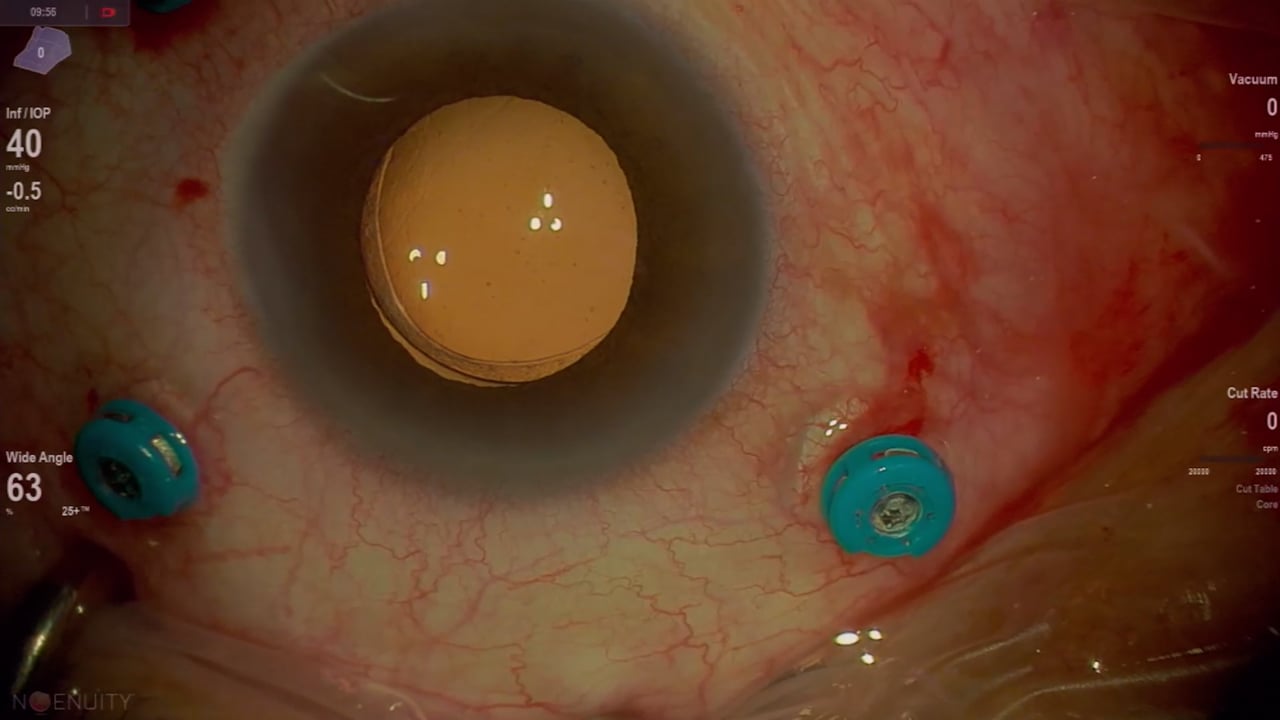 Macular hole in high myopic patient