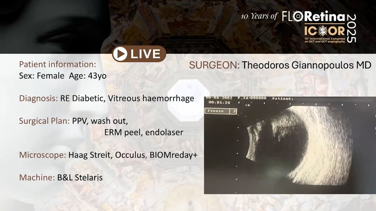 RE Diabetic, Vitreous Haemorrage