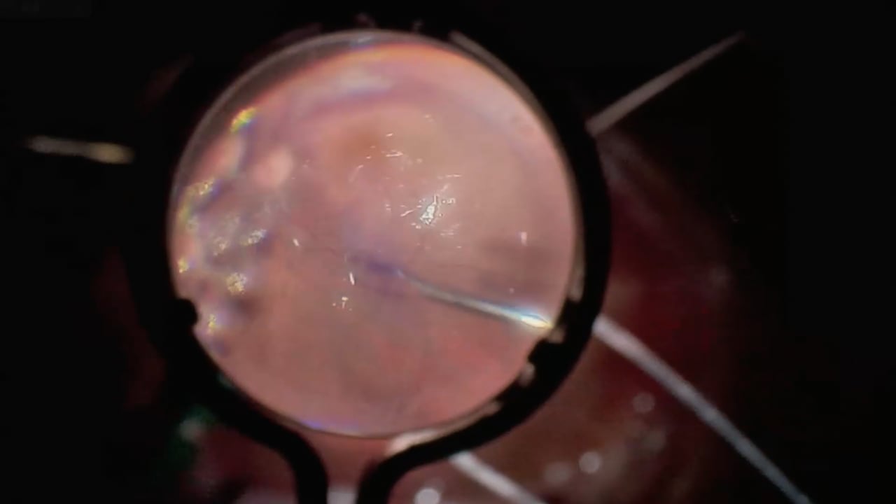 Retinal detachment post PPV