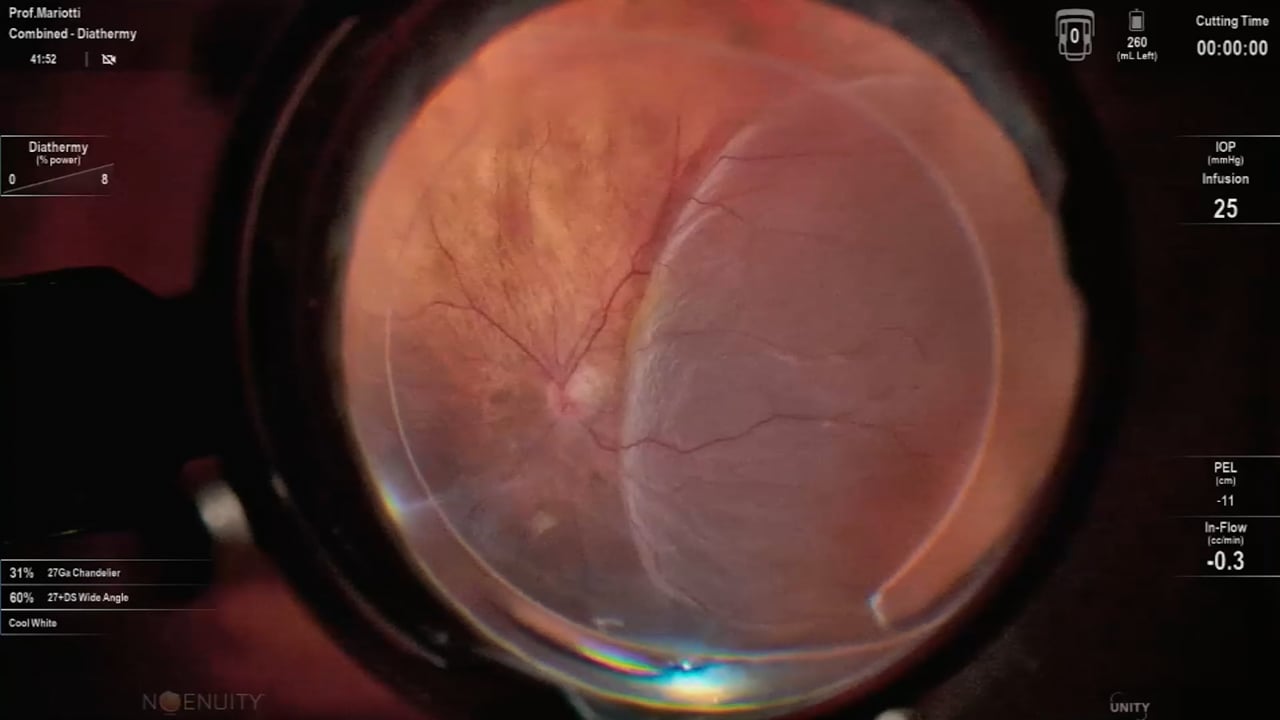 Retinal detachment, phakic eye