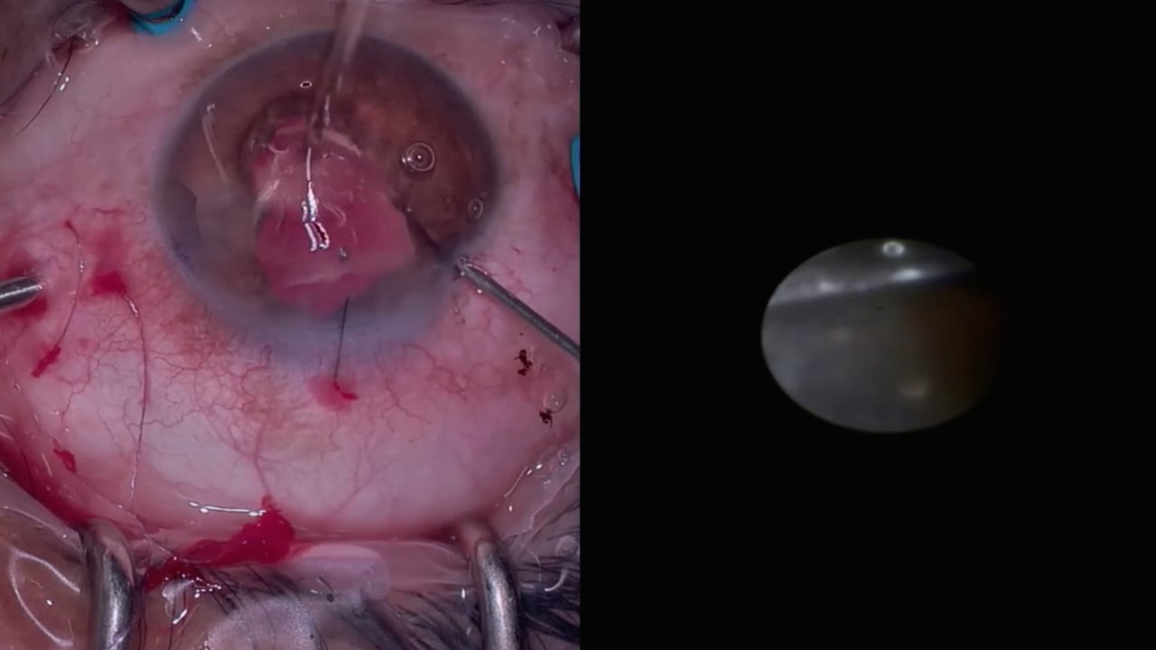 Cataract + diabetic TDR