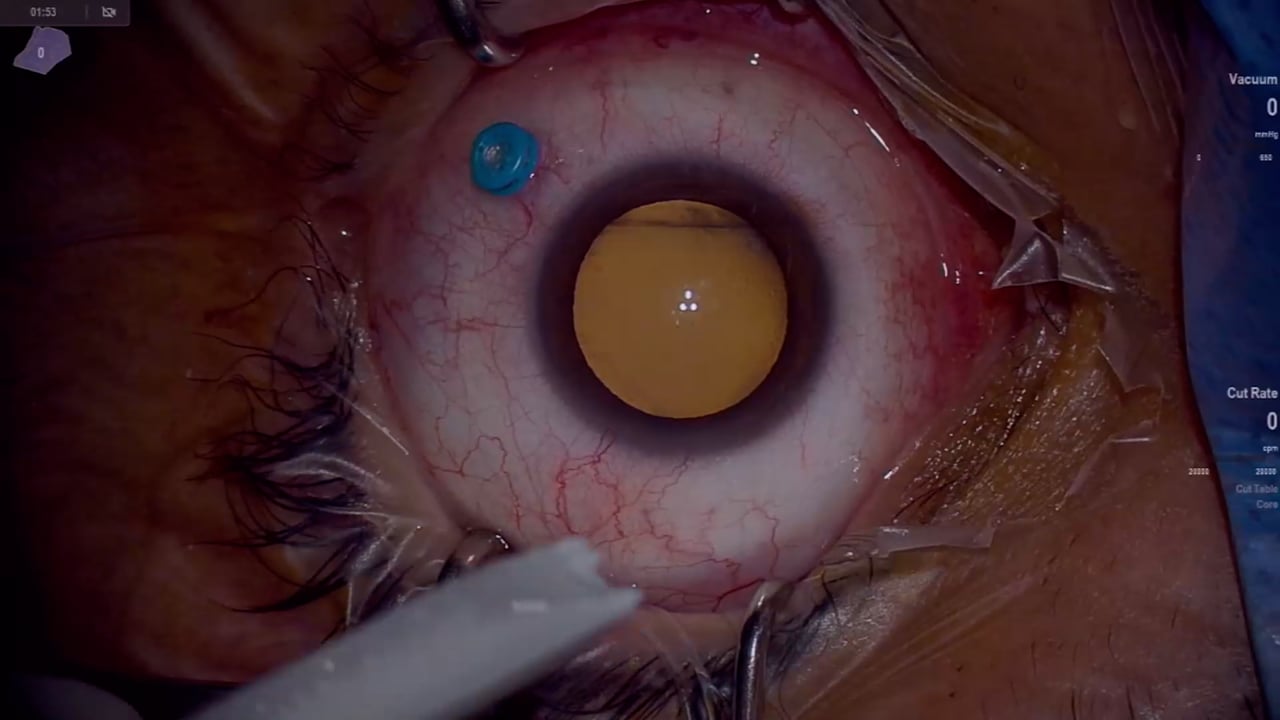Retinal detachment with subretinal fibrotic bands