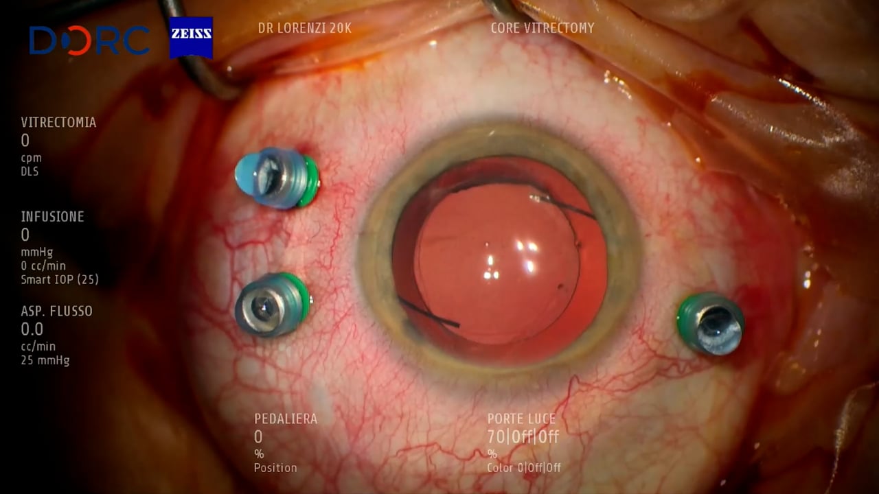 Pseudo-phakic retinal detachment