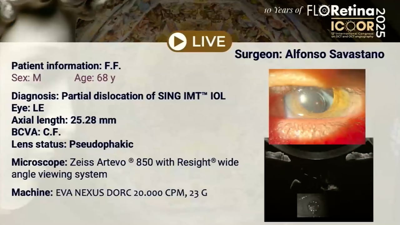 Partial dislocation of SING IMT IOL