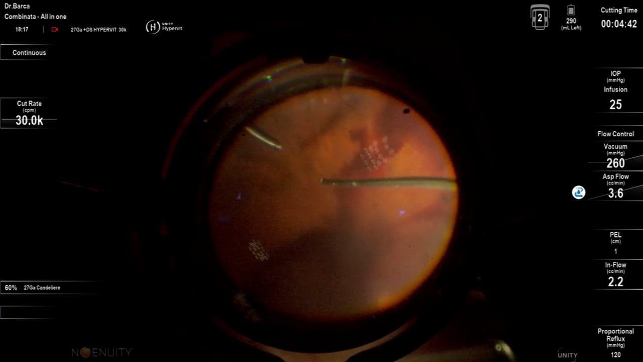 Vitreous hemorrage, secondary to proliferative Diabetic Retinopathy