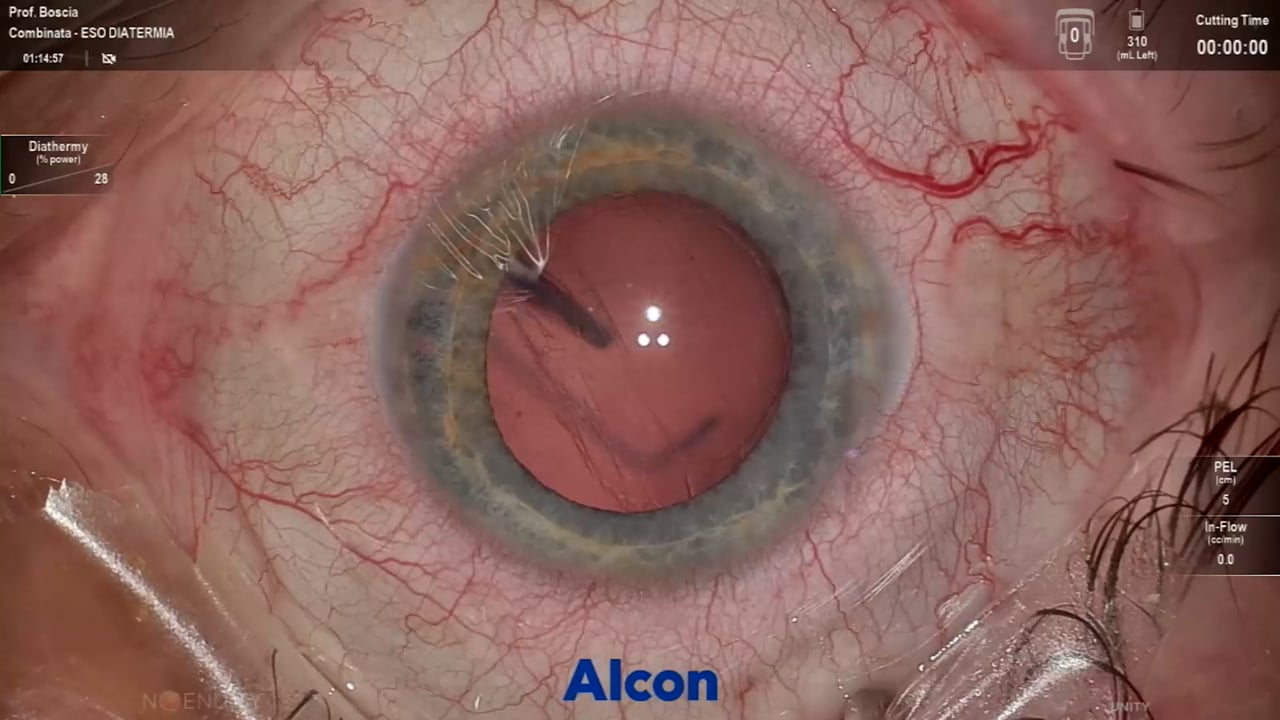 Capsular bag complex luxated