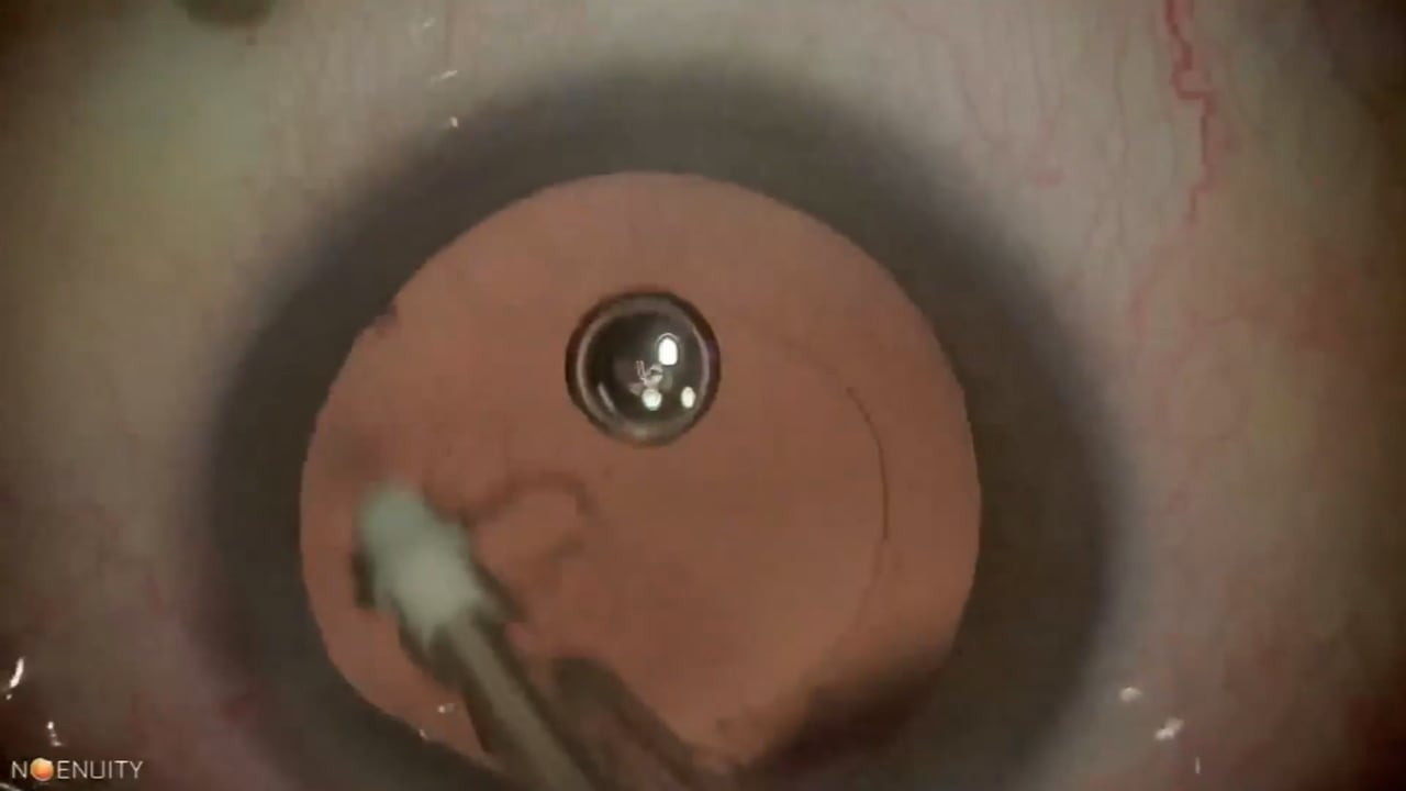 Myopic traction maculopathy