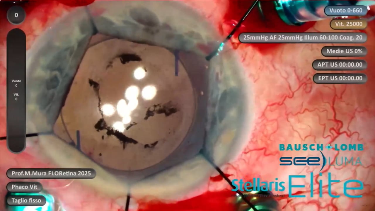 Tractional retinal detachment