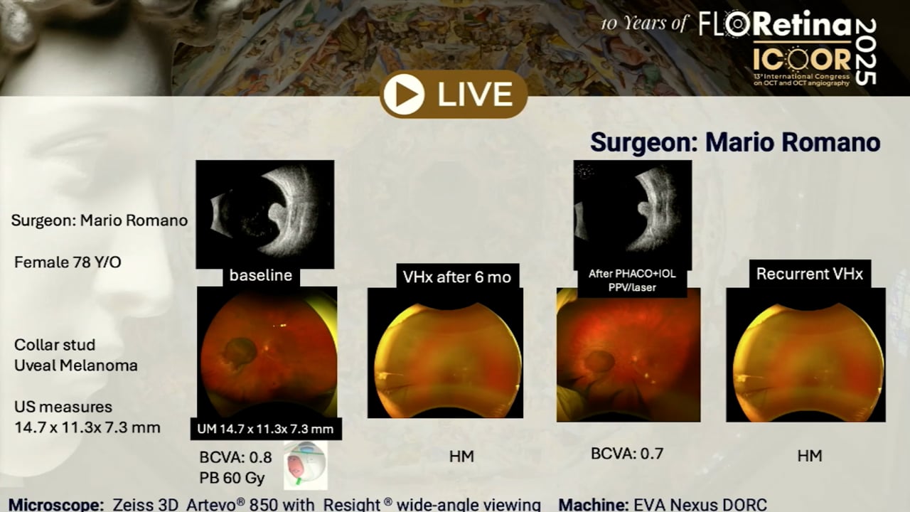 Collar stud uveal melanoma