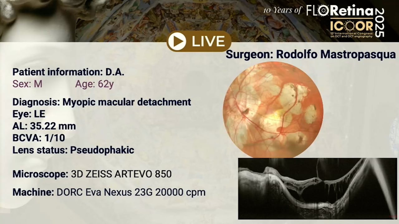 Myopic macular detachment