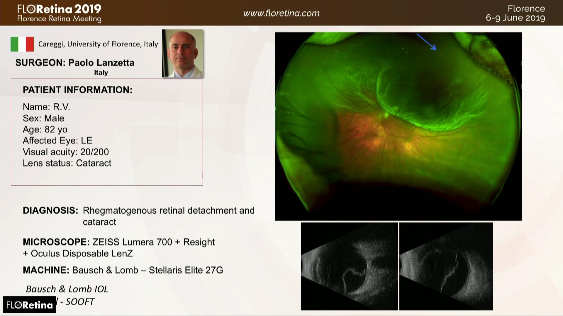 Rhegmatogenous Retinal Detachment and Cataract