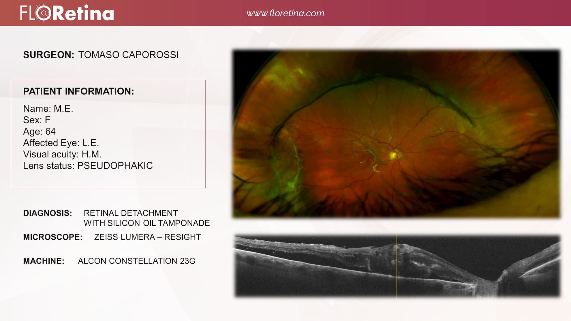 Retinal Detachment With Silicon Oil Tamponade