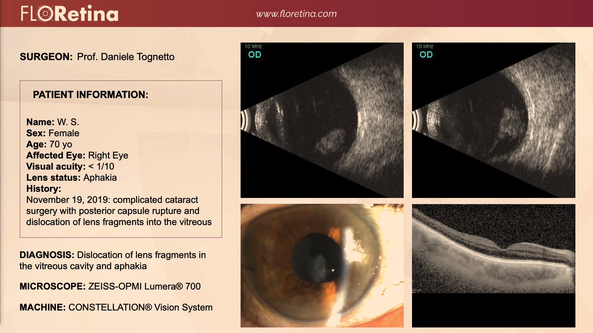 Dislocation Of Lens Fragments In The Vitreous Cavity And Aphakia