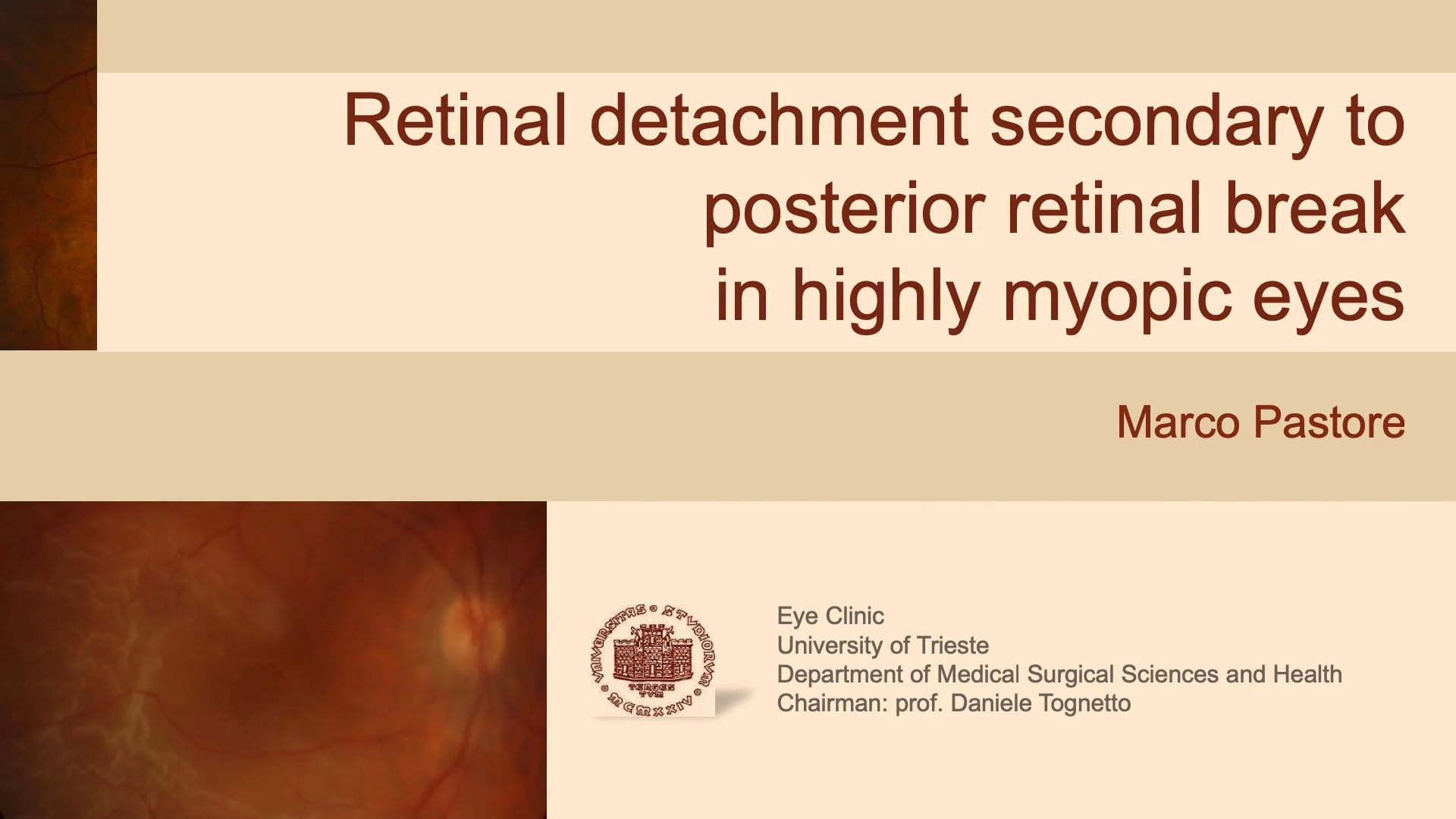 Retinal Detachment Secondary To Posterior Retinal Break In Highly Myopic Eyes