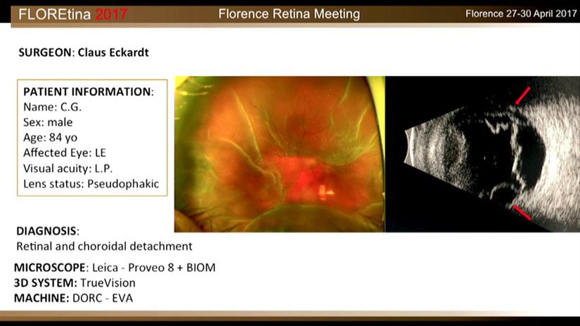 Retinal And Choroidal Detachment