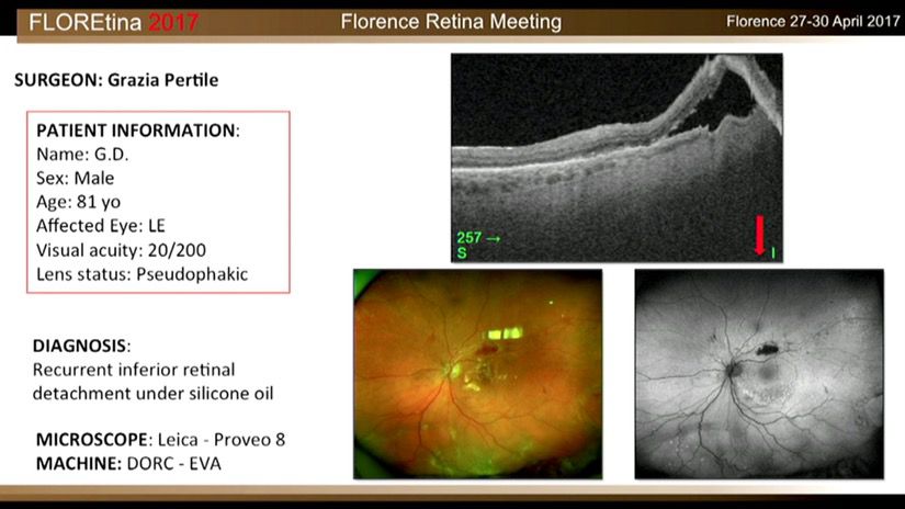 Recurrent Inferior Retinal Detachment Under Silicone Oil