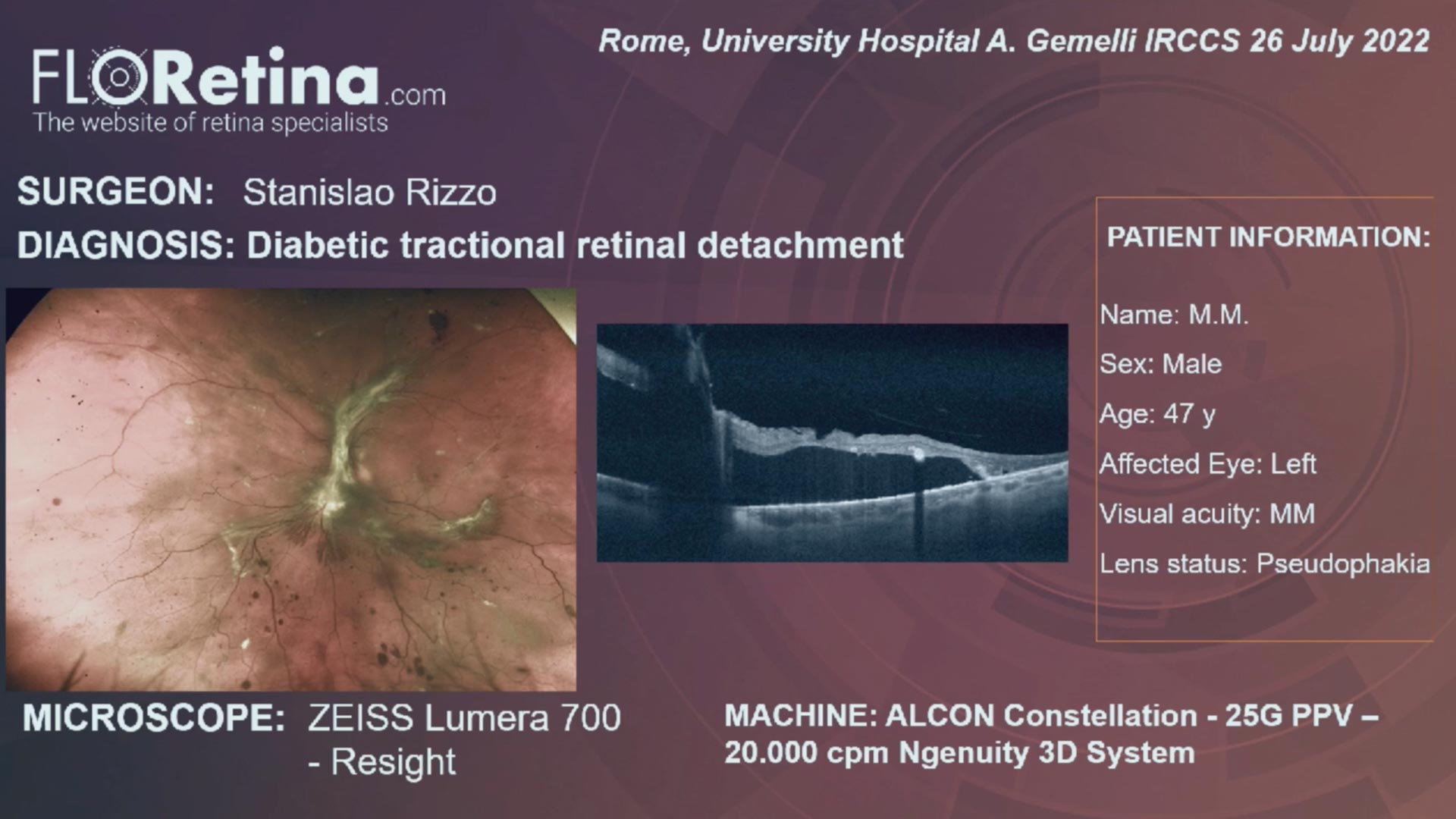 DIABETIC TRACTIONAL RETINAL DETACHMENT (Rome, 26/07/2022)