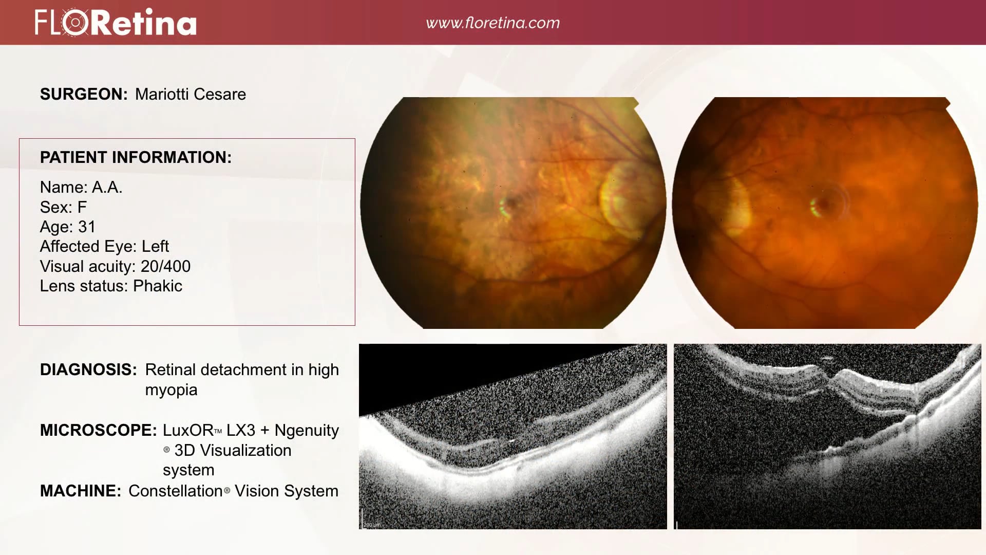 Retinal Detachment In High Myopia